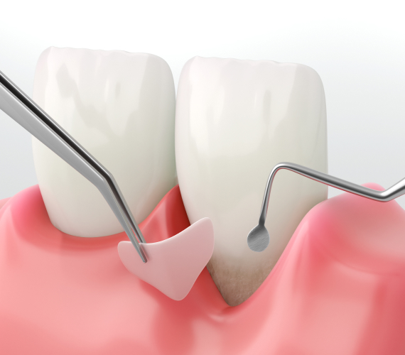 歯周外科治療について
