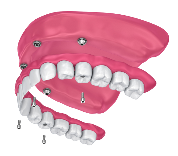 インプラントオーバーデンチャーという選択肢
