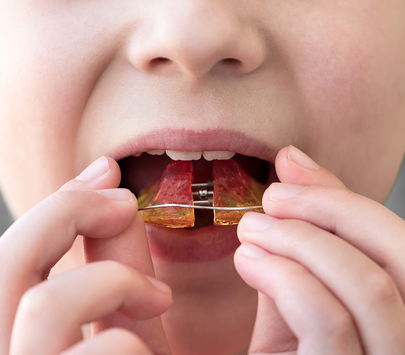 小児矯正について