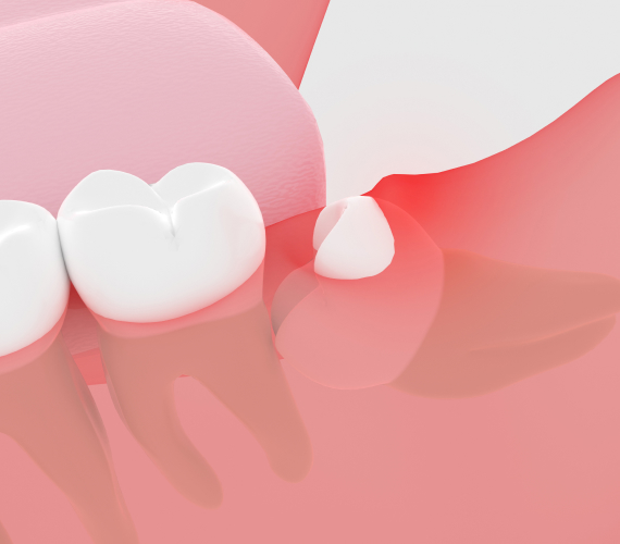 智歯周囲炎とは